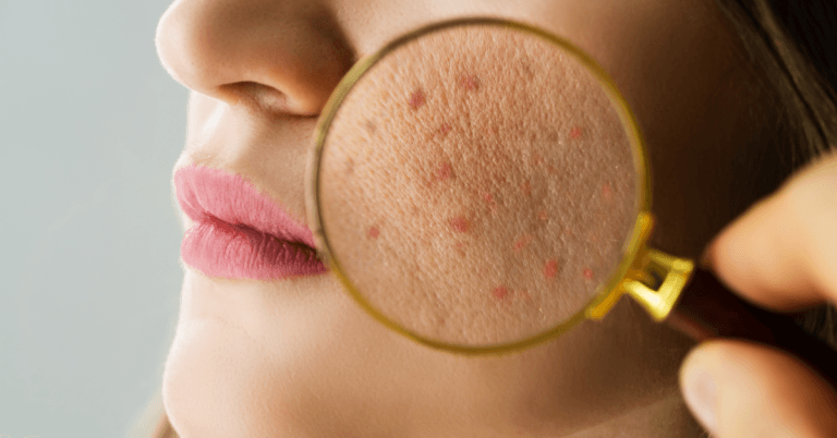 acne rimedi pelle acneica pelle impura