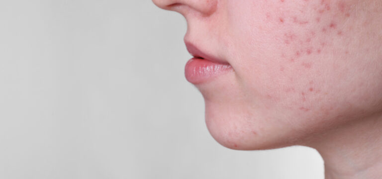 acne rimedi pelle acneica pelle impura