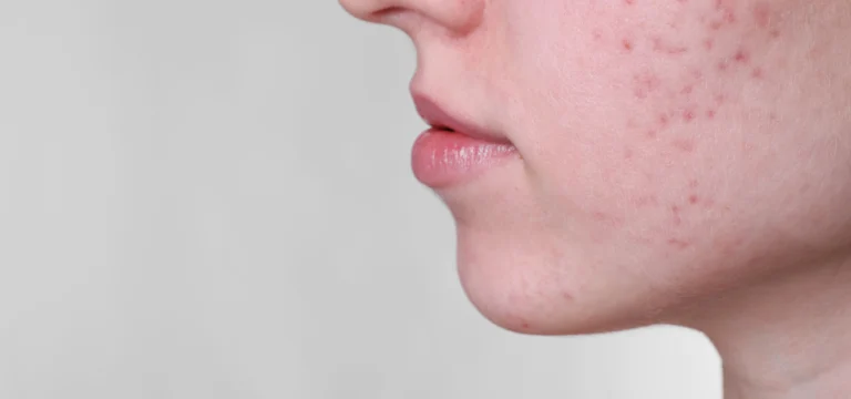 acne rimedi pelle acneica pelle impura
