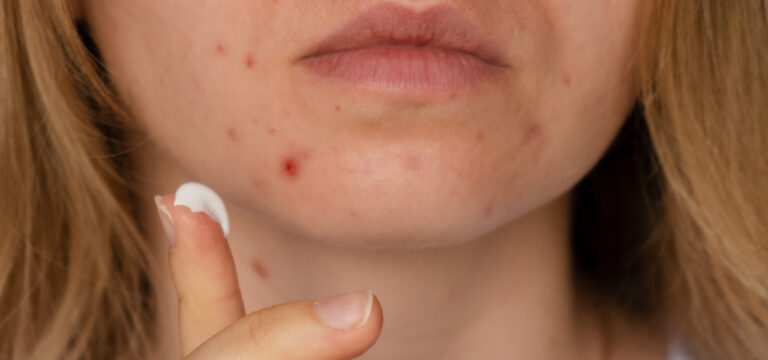prodotti pelle grassa pelle impura skincare purificante