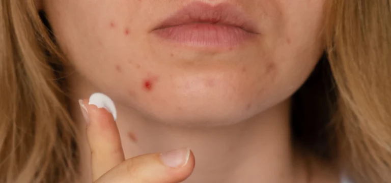 prodotti pelle grassa pelle impura skincare purificante