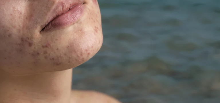 come trattare la pelle grassa in estate