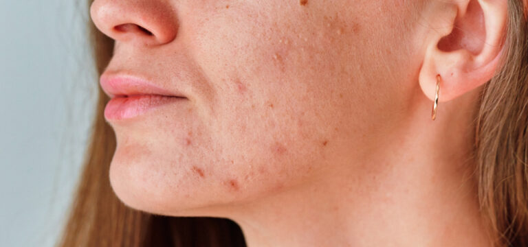 pelle a tendenza acneica brufoli sottopelle rimedi acne e punti neri