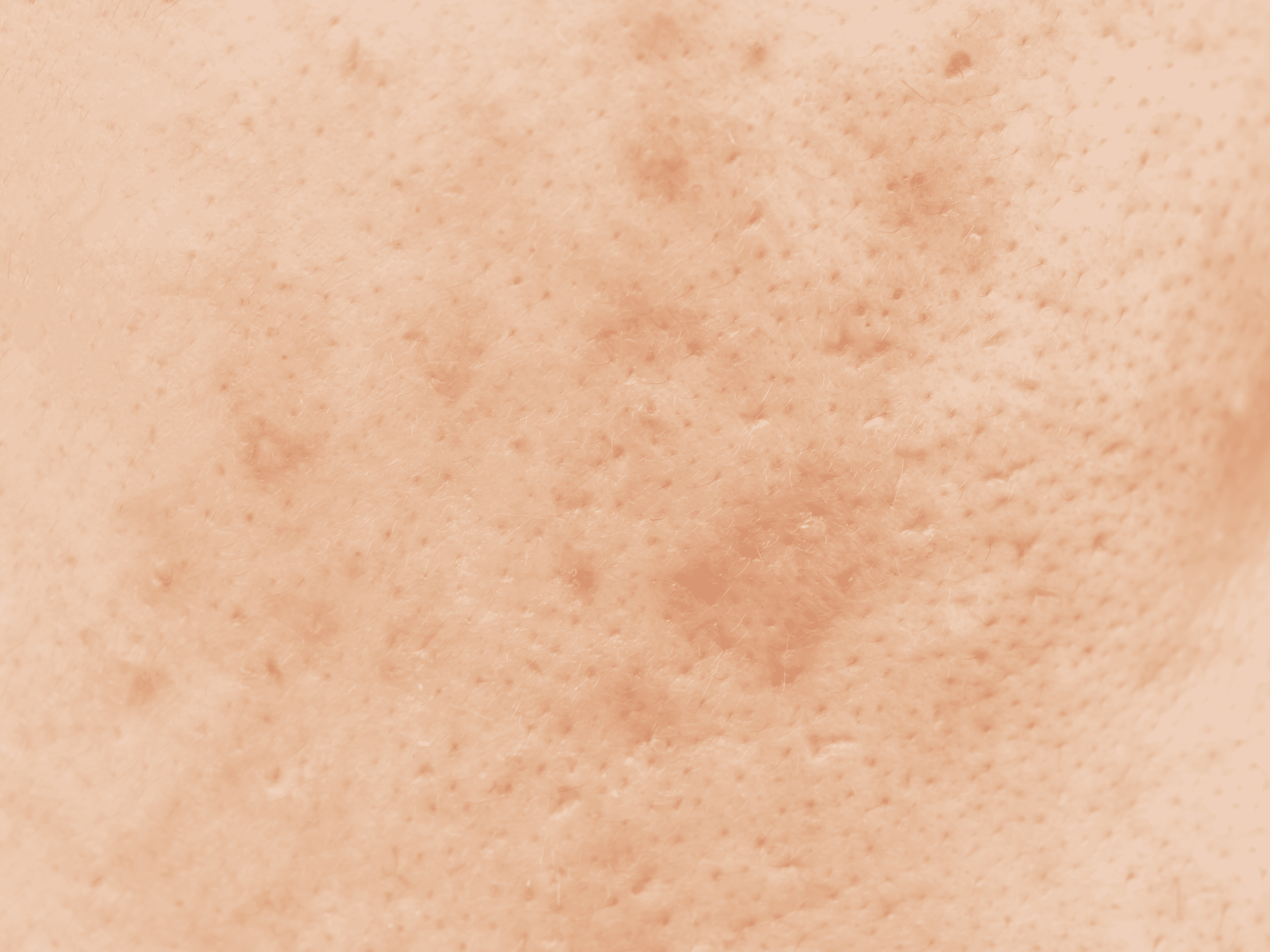 Protocollo per pelle con macchie skincare per pelli con discromie