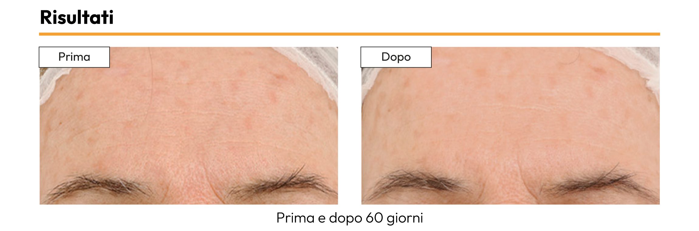 Risultati prima e dopo 60 giorni - Siero viso Anti-Macchie